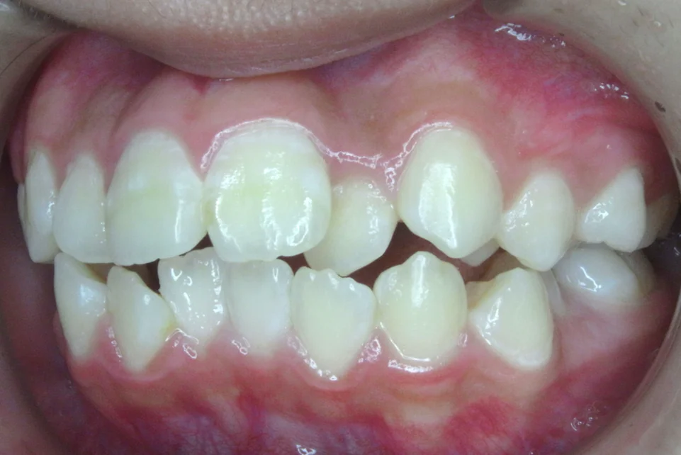 ひまわり歯科矯正歯科 全顎矯正③ before 左側面