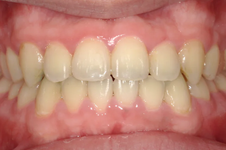 ひまわり歯科矯正歯科 全顎矯正① after 正面