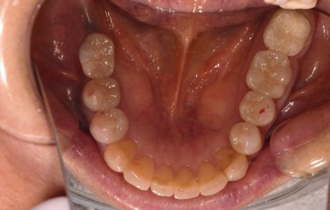 横浜日吉おおとう歯科-インプラント　セラミッククラウン②-after-下