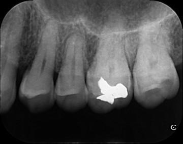 戸越なかやま歯科＋Er:YAGレーザーを併用した歯周組織再生療法＋After