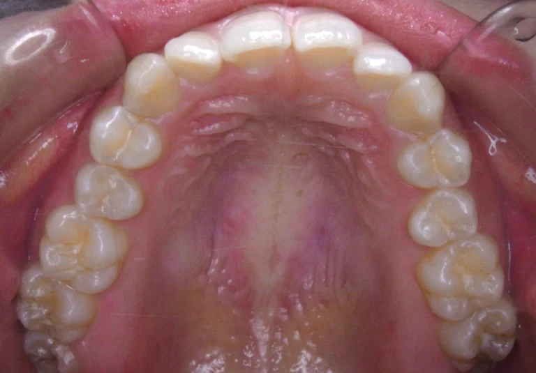 ひまわり歯科矯正歯科 全顎矯正④ before 上顎口腔内