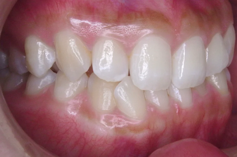 ひまわり歯科矯正歯科 全顎矯正④ before 右側面