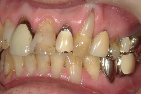 横浜日吉おおとう歯科-セラミッククラウン、ダイレクトボンディング、歯肉移植（結合組織移植）-before-正面