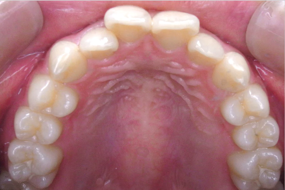 ひまわり歯科矯正歯科 全顎矯正② before 上顎口腔内