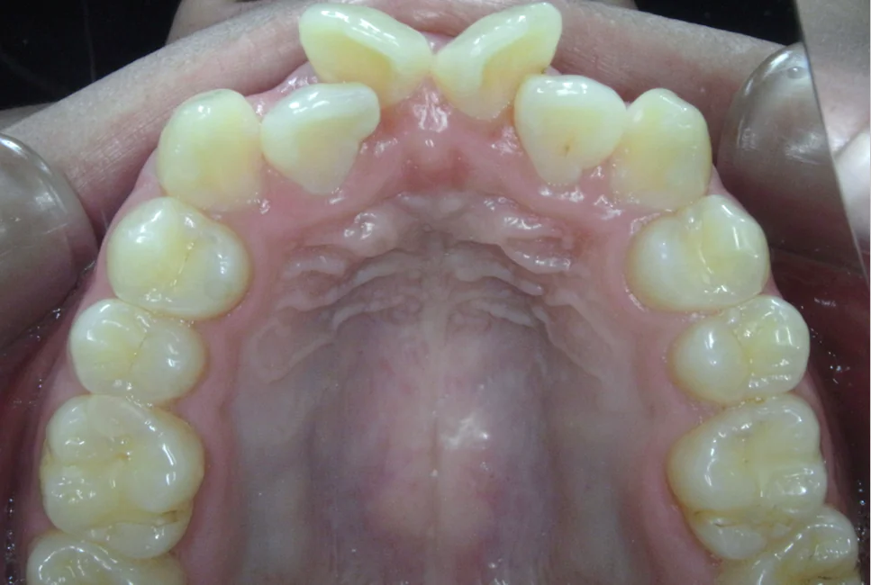 ひまわり歯科矯正歯科 部分矯正④ before 上顎口腔内
