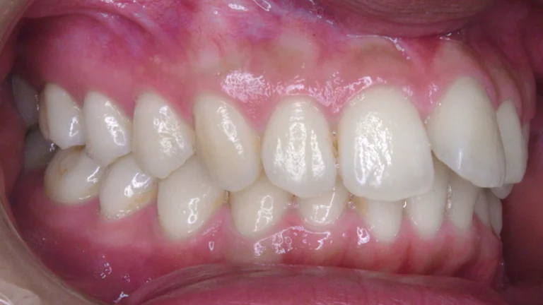 ひまわり歯科矯正歯科 全顎矯正⑤ before 右側面