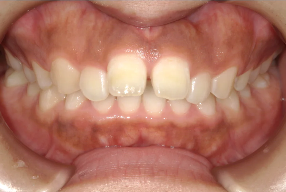 ひまわり歯科矯正歯科 部分矯正⑥ before 正面