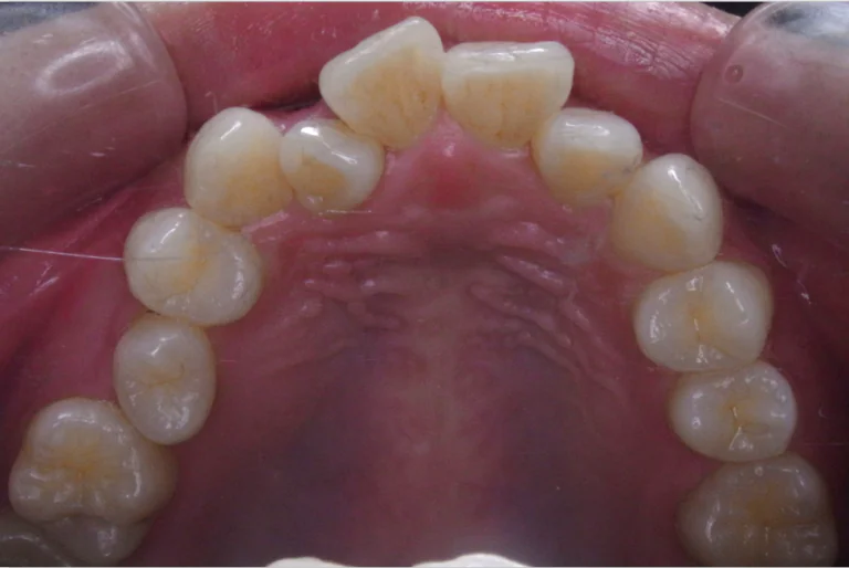 ひまわり歯科矯正歯科 全顎矯正⑥ before 上顎口腔内