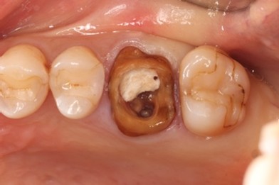 戸越なかやま歯科＋歯根破折した歯に対してRidge Preservationを行いインプラント埋入を行ったケースの症例＋before