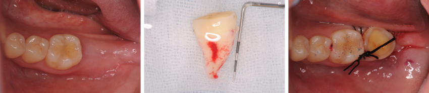 戸越なかやま歯科＋親知らずを移植し咬み合わせを作ったケース＋移植歯の根幹治療終了時