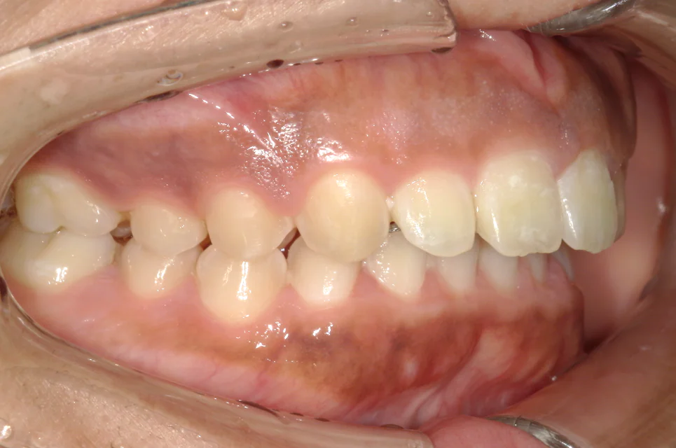 ひまわり歯科矯正歯科 部分矯正⑥ after 右側面