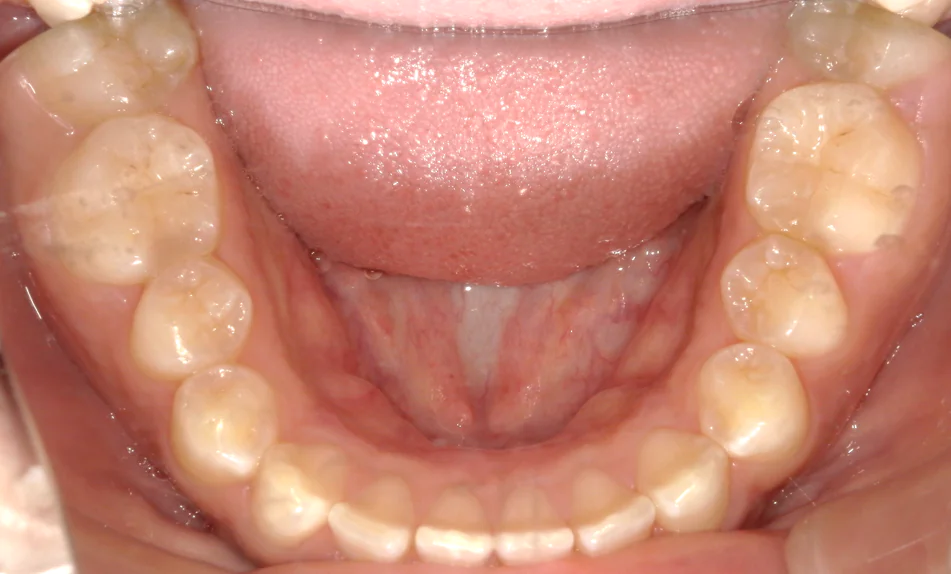 ひまわり歯科矯正歯科 部分矯正⑥ before 下顎口腔内