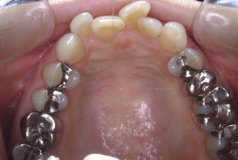 ひまわり歯科矯正歯科 部分矯正② before 上顎口腔内