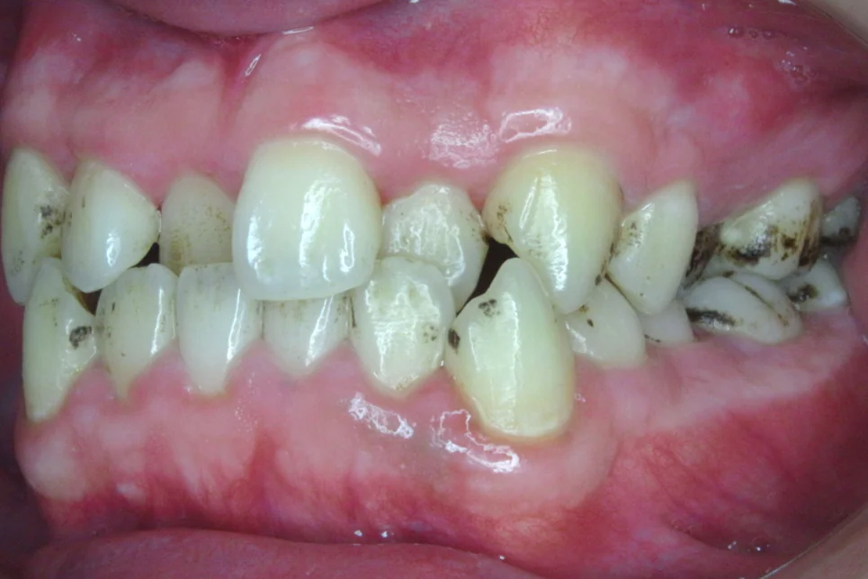 ひまわり歯科矯正歯科 全顎矯正① before 左側面