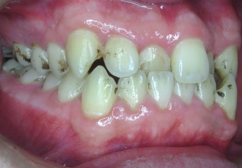 ひまわり歯科矯正歯科 全顎矯正① before 右側面