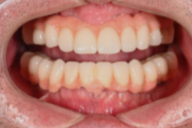 医療法人社団 颯美会 まえだ歯科 南町田グランベリーパーク院オールオン4①after