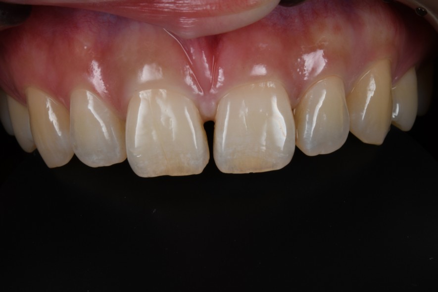 横浜日吉おおとう歯科-ダイレクトボンディング-before