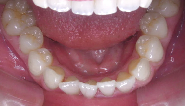 ひまわり歯科矯正歯科 全顎矯正⑥ before 下顎口腔内