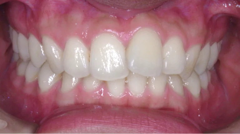 ひまわり歯科矯正歯科 全顎矯正⑤ before 正面