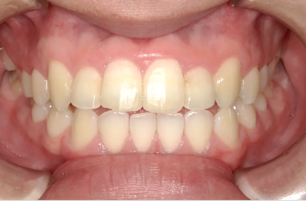 ひまわり歯科矯正歯科 部分矯正④ after 正面