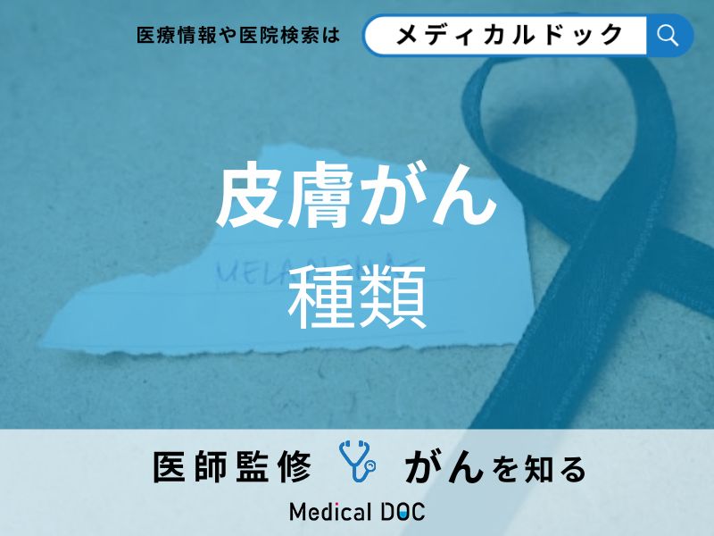「皮膚がんの種類」とは?原因やできやすい部位なども解説!【医師監修】