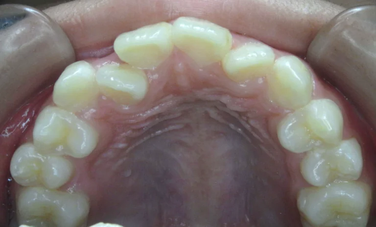 ひまわり歯科矯正歯科 全顎矯正③ before 上顎口腔内