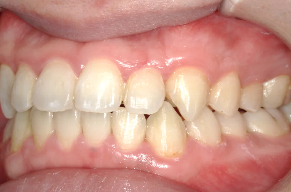 ひまわり歯科矯正歯科 全顎矯正① after 左側面