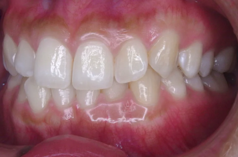 ひまわり歯科矯正歯科 全顎矯正④ before 左側面