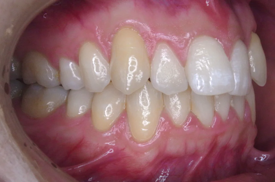 ひまわり歯科矯正歯科 部分矯正⑤ before 右側面