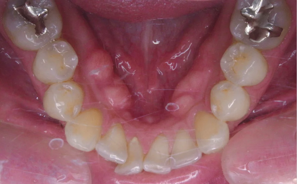 ひまわり歯科矯正歯科 部分矯正⑤ before 下顎口腔内