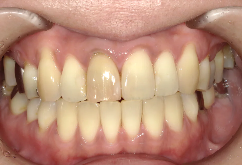 ひまわり歯科矯正歯科 部分矯正② after 正面