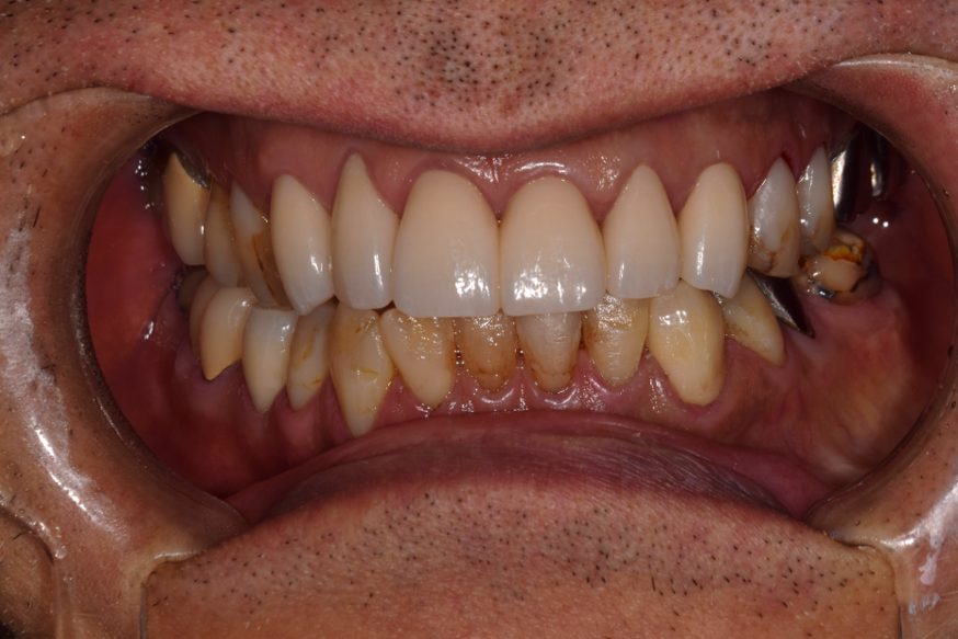 横浜日吉おおとう歯科-セラミッククラウン　ダイレクトボンディング-after-正面