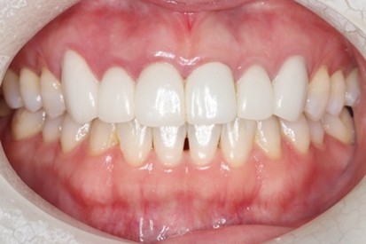 戸越なかやま歯科＋歯周病患者に対して前歯部に審美修復を行ったケース＋before
