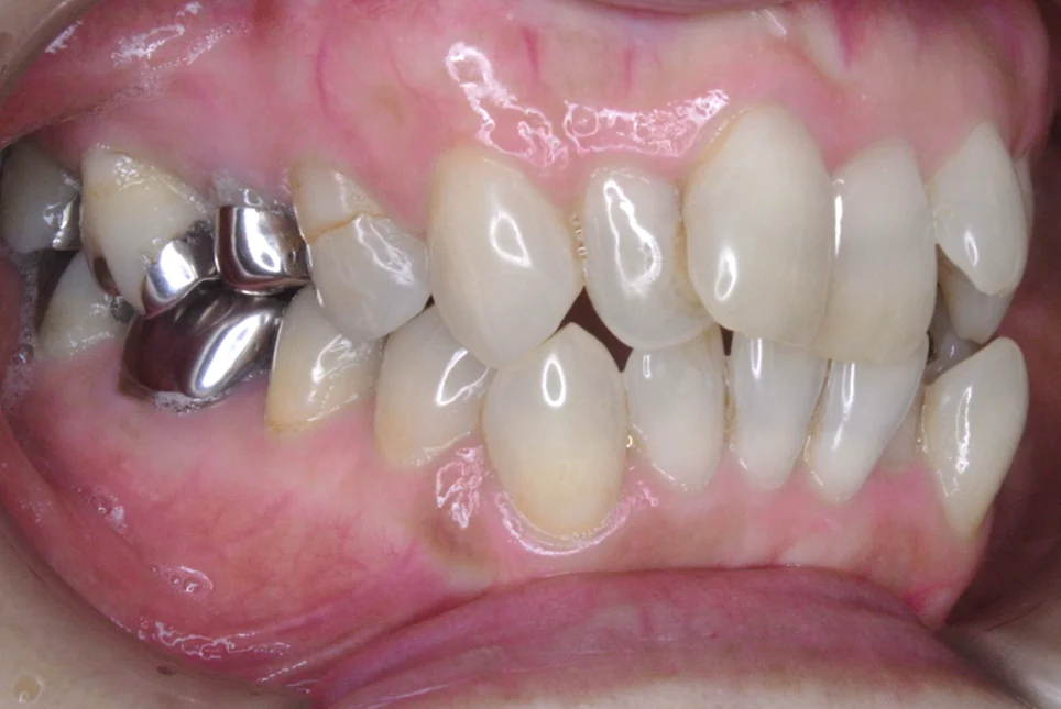 ひまわり歯科矯正歯科 部分矯正② before 右側面