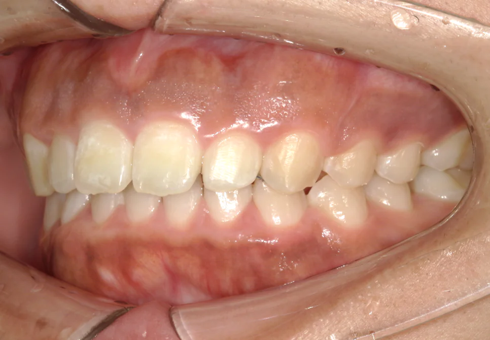 ひまわり歯科矯正歯科 部分矯正⑥ after 左側面