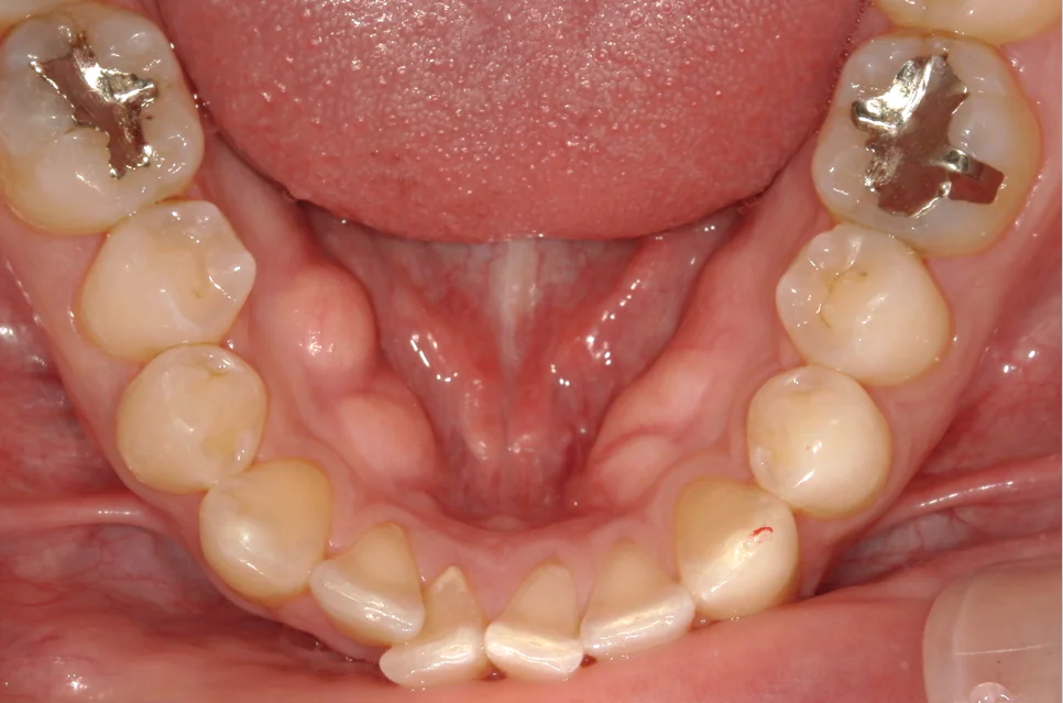 ひまわり歯科矯正歯科 部分矯正⑤ after 下顎口腔内