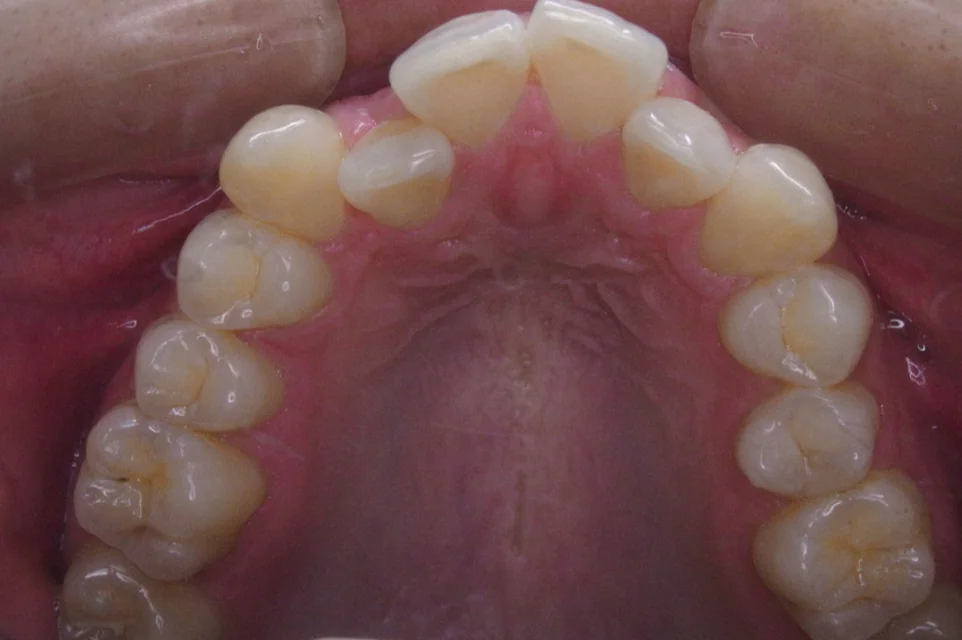 ひまわり歯科矯正歯科 部分矯正⑤ before 上顎口腔内