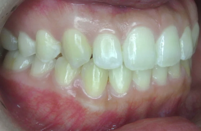 ひまわり歯科矯正歯科 全顎矯正④ after 右側面