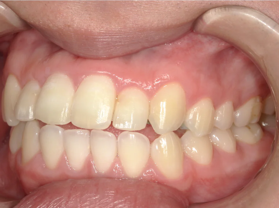 ひまわり歯科矯正歯科 部分矯正④ after 左側面