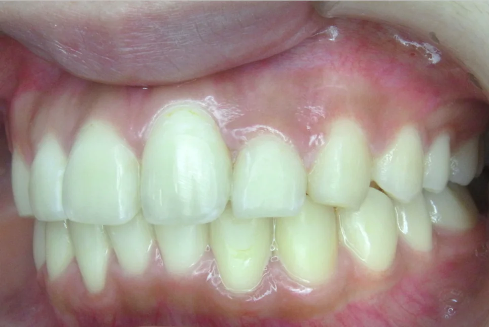 ひまわり歯科矯正歯科 全顎矯正② after 左側面