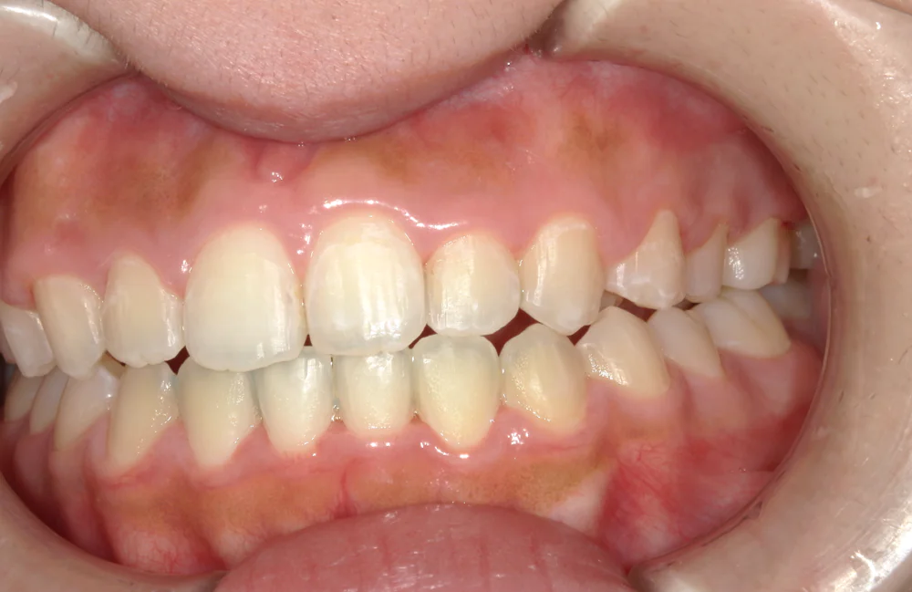 ひまわり歯科矯正歯科 部分矯正③ after 左側面