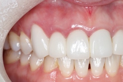 戸越なかやま歯科＋歯周病患者に対して前歯部に審美修復を行ったケース＋before