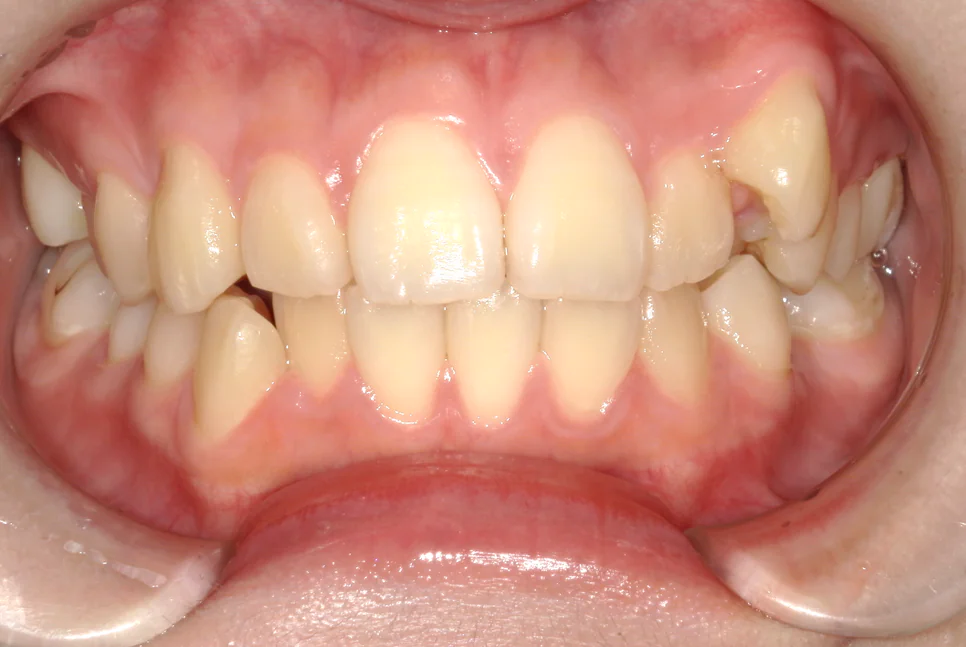 ひまわり歯科矯正歯科 部分矯正① before 正面