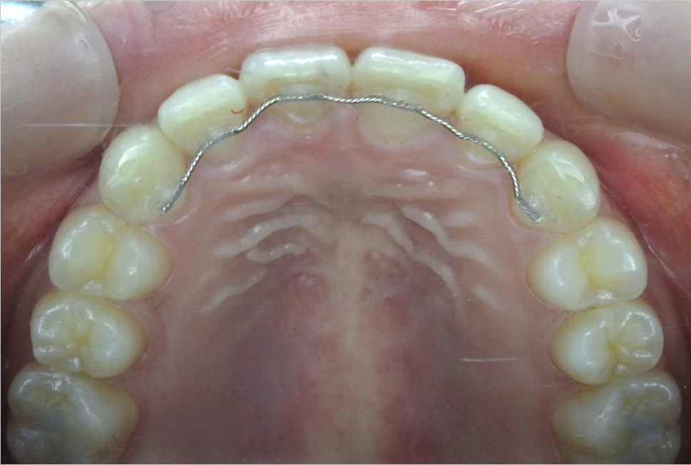 ひまわり歯科矯正歯科 全顎矯正② after 上顎口腔内