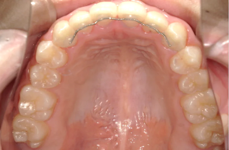 ひまわり歯科矯正歯科 部分矯正③ after 上顎口腔内