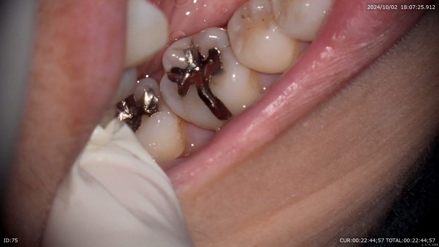 西新宿五丁目デンタルクリニック1Dayセラミックbefore