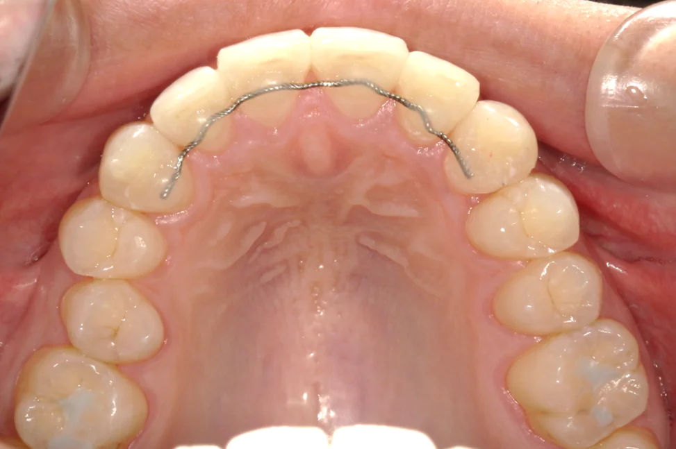 ひまわり歯科矯正歯科 部分矯正⑤ after 上顎口腔内