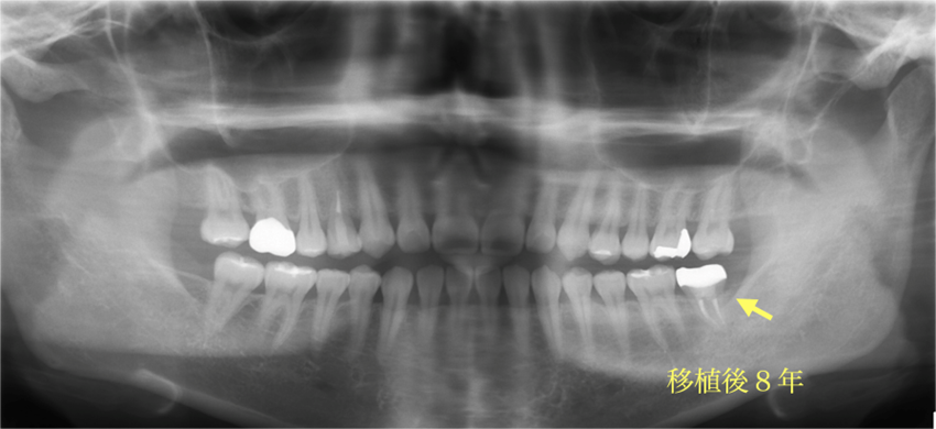 なかやま歯科＋親知らずを移植し咬み合わせを作ったケース＋afterの症例