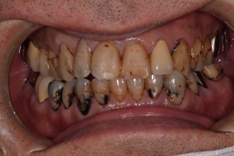 横浜日吉おおとう歯科-セラミッククラウン　ダイレクトボンディング-正面