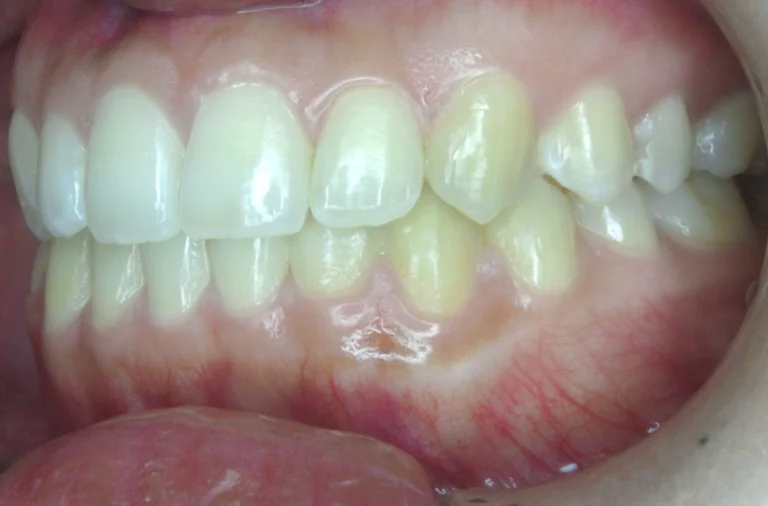 ひまわり歯科矯正歯科 全顎矯正④ after 左側面